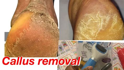 How a Magic Callus Remover Jar Can Transform Your Foot Care Routine